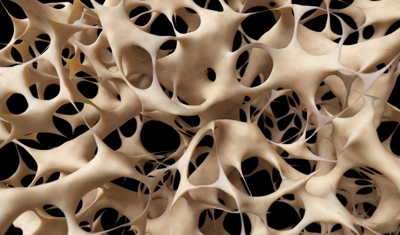 Os touché par ostéoporose
